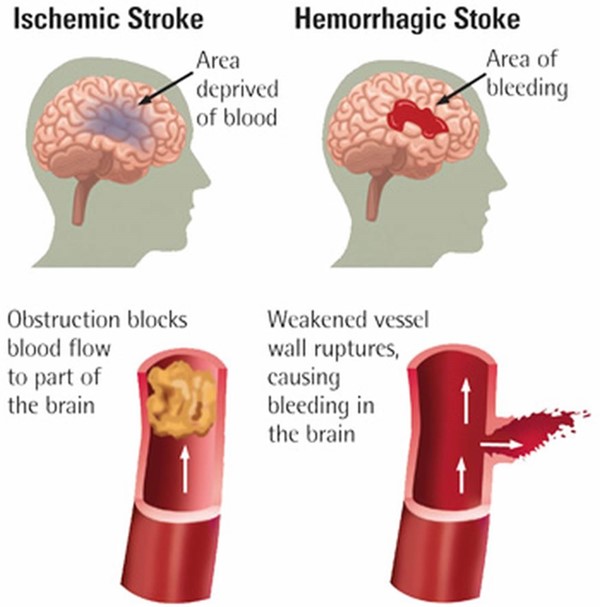 Diagram of different types of strokes